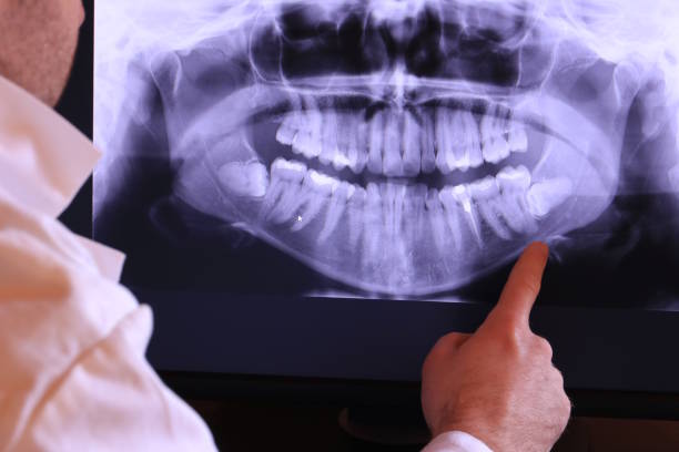 Best Knocked-Out Tooth (Avulsed Tooth) Treatment in Stillwater, MN